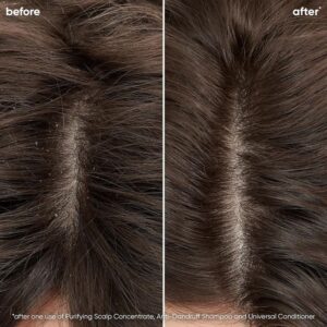 Dandruff Treatment